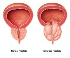 Prostate Enlargement And UroLift