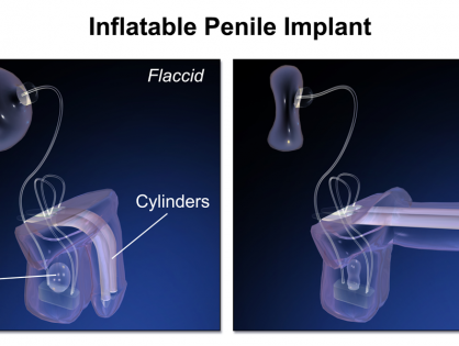 Penile Implants For ED
