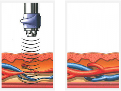Erectile dysfunction shockwave therapy for Shockwave treatment